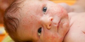 Dermatite Infantil