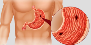 úlcera no estômago
