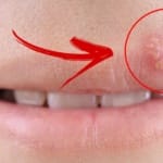 Herpes Labial