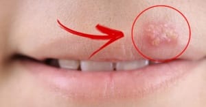 Herpes Labial