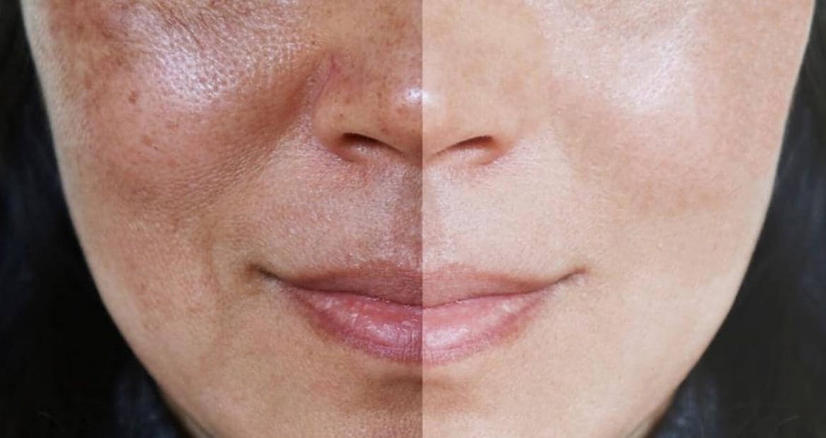 o que é Melasma