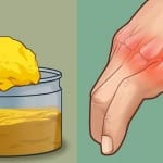 artrite reumatoide