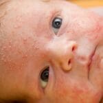 Dermatite Infantil