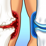 Ligamentos nos joelhos