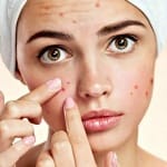 tratar e prevenir acne