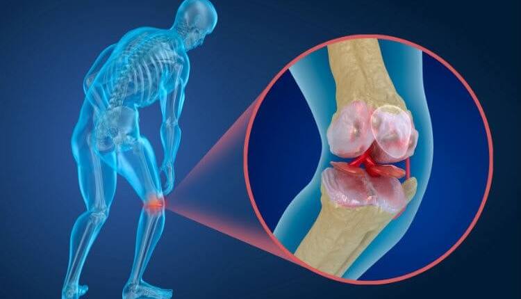 osteoartrite