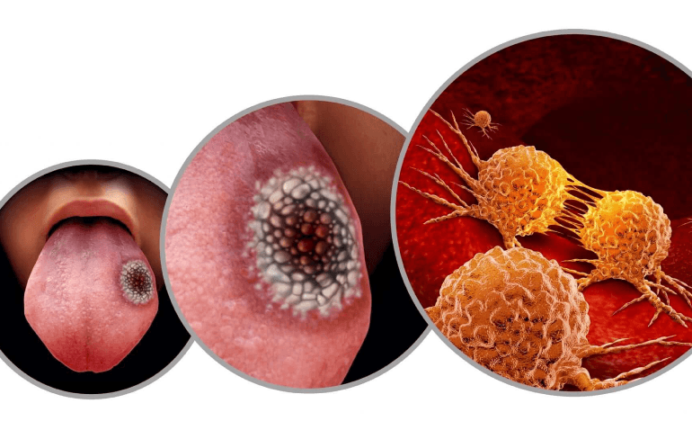 cancer oral