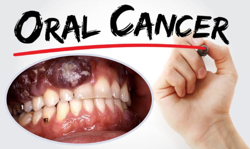 cancer de boca