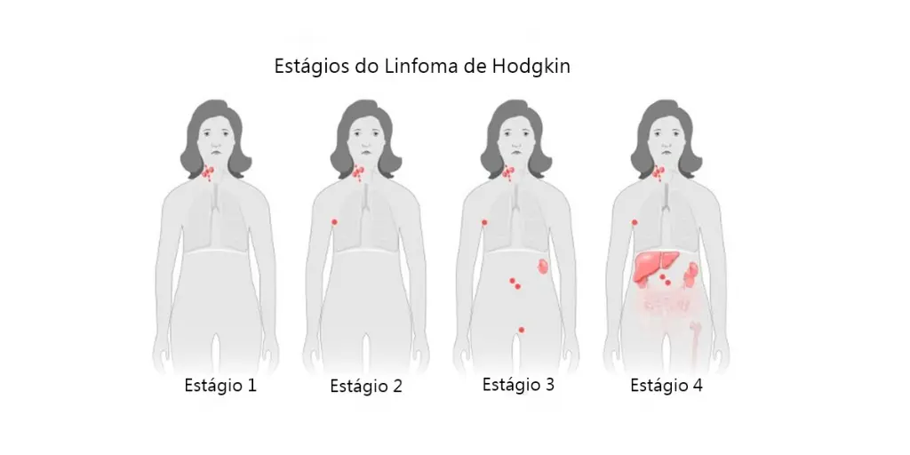 Linfoma de Hodgkin