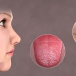 sindrome de sjogren