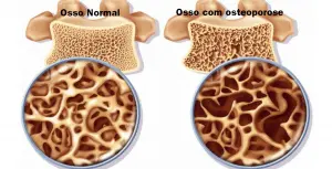 Osteoporose