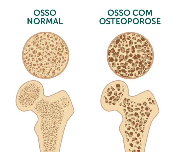 tratamento osteoporose