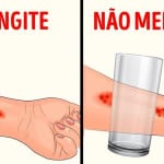 meningite