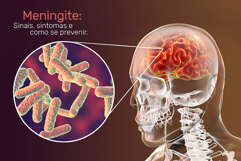meningite meningocócica