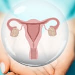 miomas uterinos