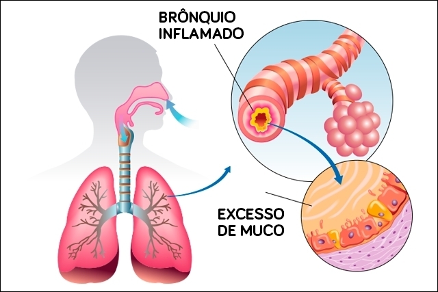 bronquite e pneumonia
