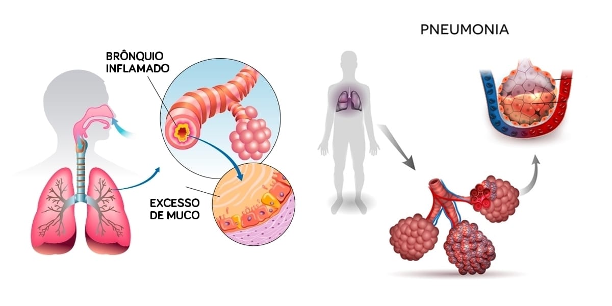 Bronquiolite E Pneumonia Juntos - RETOEDU