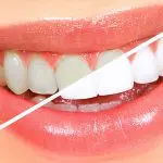 dentes amarelos