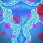 miomas uterinos