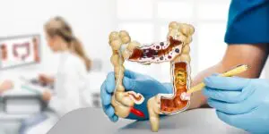 Câncer de intestino